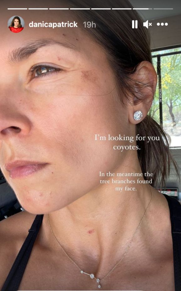 Danica Patrick Shows Off Injuries After Attack (Photos) 2